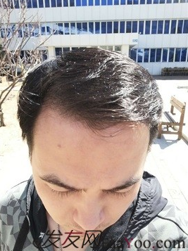 北京南加植發(fā)唐醫(yī)生種植3500單位一年效果恢復(fù)全程記錄