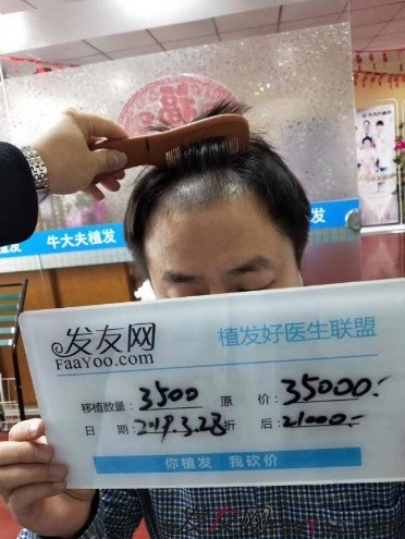 沈陽牛大夫植發(fā)好醫(yī)生優(yōu)惠活動,3900單位看最后效果