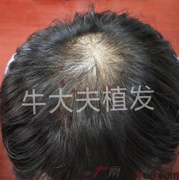 沈陽牛大夫植發(fā)好醫(yī)生優(yōu)惠活動,3900單位看最后效果