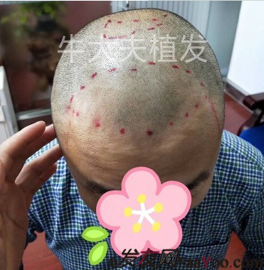 沈陽牛大夫植發(fā)好醫(yī)生優(yōu)惠活動,3900單位看最后效果