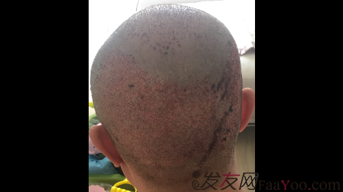 沈陽牛大夫植發(fā)好醫(yī)生優(yōu)惠活動,3900單位看最后效果