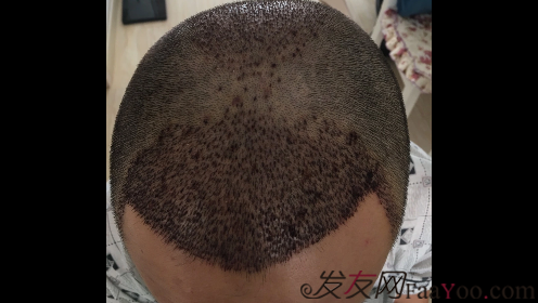 沈陽牛大夫植發(fā)好醫(yī)生優(yōu)惠活動,3900單位看最后效果