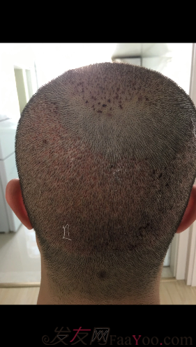 沈陽牛大夫植發(fā)好醫(yī)生優(yōu)惠活動,3900單位看最后效果