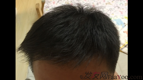 沈陽牛大夫植發(fā)好醫(yī)生優(yōu)惠活動,3900單位看最后效果