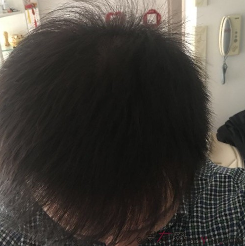 沈陽牛大夫植發(fā)好醫(yī)生優(yōu)惠活動,3900單位看最后效果