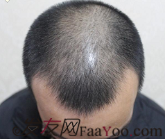 植發(fā)日記南昌廣濟(jì)植發(fā)，慢慢看我改變從此恢復(fù)自信