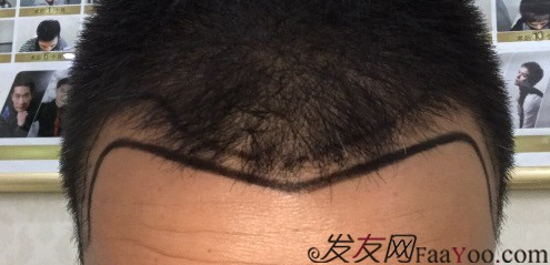 西安大麥微針前額植發(fā)，切勿病急亂投醫(yī)看看我的經(jīng)歷