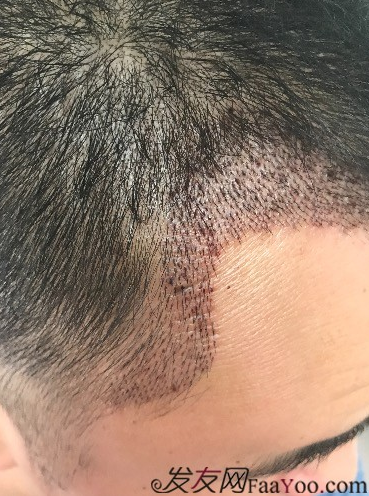 西安大麥微針前額植發(fā)，切勿病急亂投醫(yī)看看我的經(jīng)歷