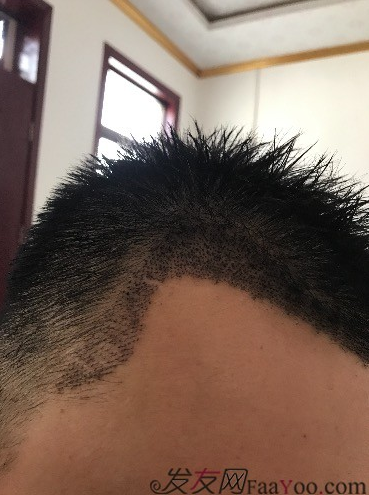 西安大麥微針前額植發(fā)，切勿病急亂投醫(yī)看看我的經(jīng)歷