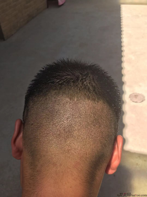 西安大麥微針前額植發(fā)，切勿病急亂投醫(yī)看看我的經(jīng)歷