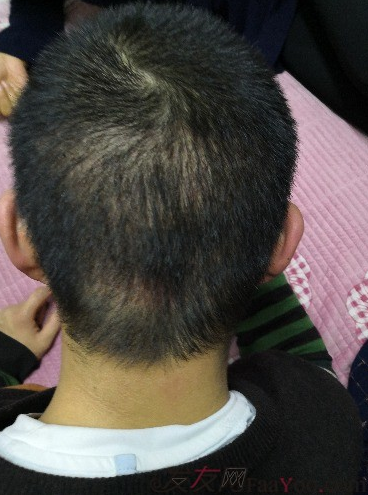 天津新發(fā)現(xiàn)植發(fā)3000單位，我來說說有頭發(fā)的感受