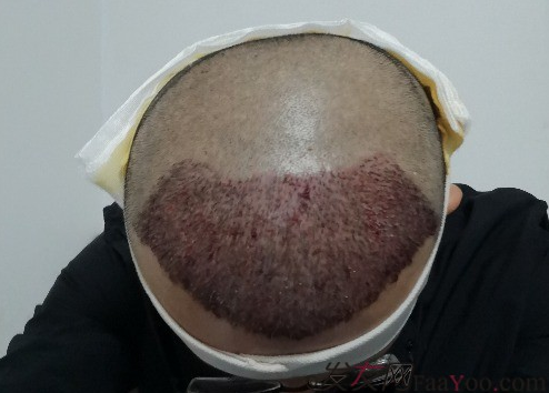 天津新發(fā)現(xiàn)植發(fā)3000單位，我來說說有頭發(fā)的感受