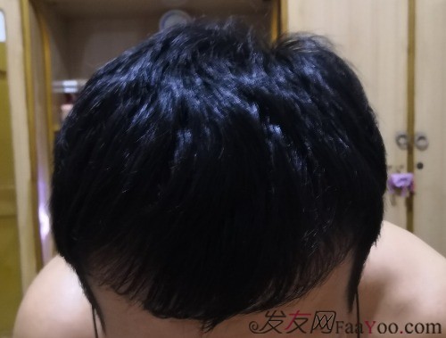 天津新發(fā)現(xiàn)植發(fā)3000單位，我來說說有頭發(fā)的感受