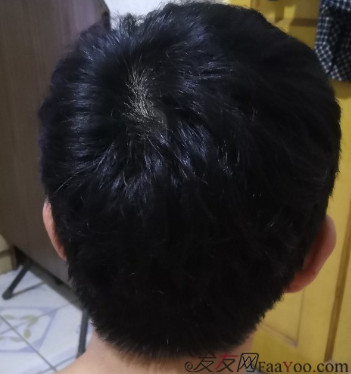 天津新發(fā)現(xiàn)植發(fā)3000單位，我來說說有頭發(fā)的感受