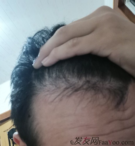 天津新發(fā)現(xiàn)植發(fā)3000單位，我來說說有頭發(fā)的感受