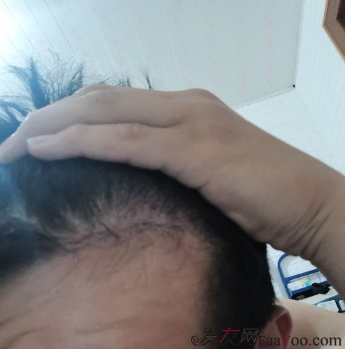 天津新發(fā)現(xiàn)植發(fā)3000單位，我來說說有頭發(fā)的感受
