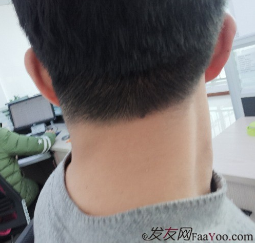 天津新發(fā)現(xiàn)植發(fā)3000單位，我來說說有頭發(fā)的感受