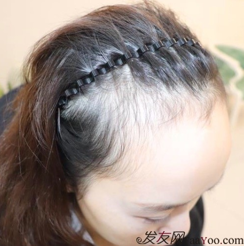 天生發(fā)際線高，通過成都大麥微針植發(fā)的一次改變