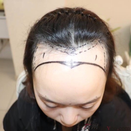 天生發(fā)際線高，通過成都大麥微針植發(fā)的一次改變