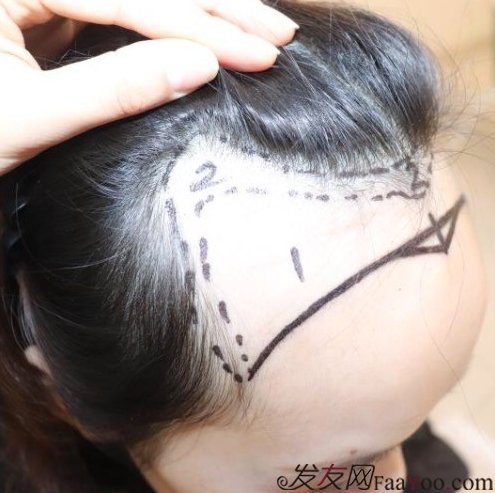 天生發(fā)際線高，通過成都大麥微針植發(fā)的一次改變