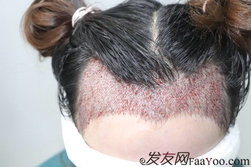 天生發(fā)際線高，通過成都大麥微針植發(fā)的一次改變