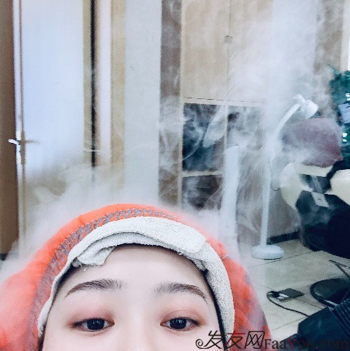 天生發(fā)際線高，通過成都大麥微針植發(fā)的一次改變