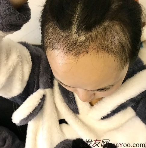 天生發(fā)際線高，通過成都大麥微針植發(fā)的一次改變