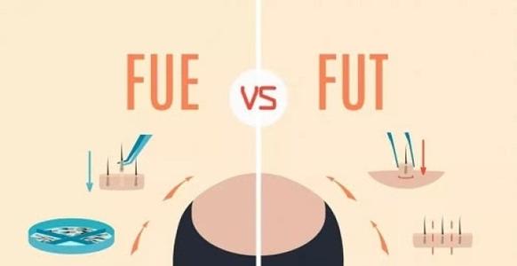 瑞麗詩植發(fā)醫(yī)院做發(fā)際線有什么優(yōu)勢