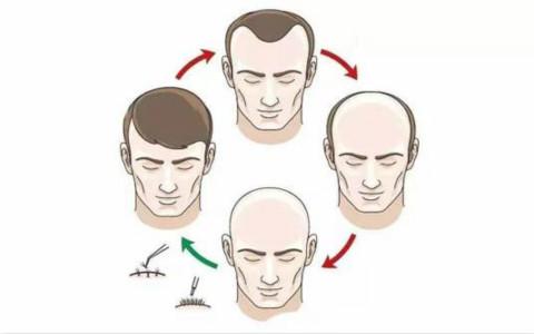 瑞麗詩(shī)植發(fā)醫(yī)院是如何保證植發(fā)效果的