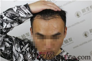 廣州新生植發(fā)，植完發(fā)后他們都說我變了