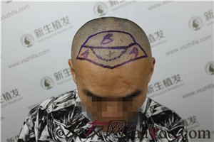 廣州新生植發(fā)，植完發(fā)后他們都說我變了