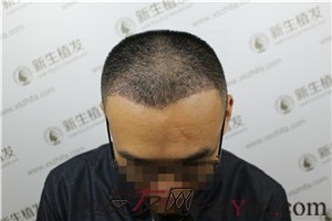 廣州新生植發(fā)，植完發(fā)后他們都說我變了