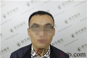 廣州新生植發(fā)，植完發(fā)后他們都說我變了