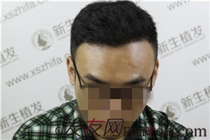 廣州新生植發(fā)，植完發(fā)后他們都說我變了