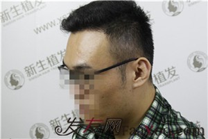 廣州新生植發(fā)，植完發(fā)后他們都說我變了