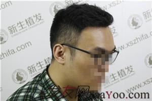 廣州新生植發(fā)，植完發(fā)后他們都說我變了