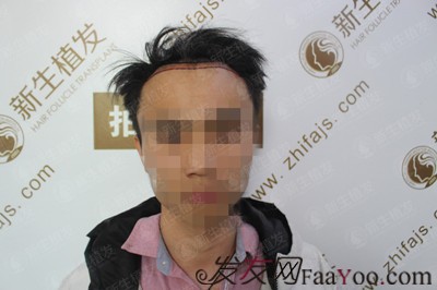 廣州新生植發(fā)發(fā)際線種植，自此以后又多了一個(gè)紀(jì)念日