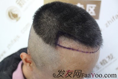 廣州新生植發(fā)發(fā)際線種植，自此以后又多了一個(gè)紀(jì)念日