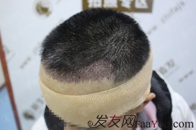 廣州新生植發(fā)發(fā)際線種植，自此以后又多了一個(gè)紀(jì)念日