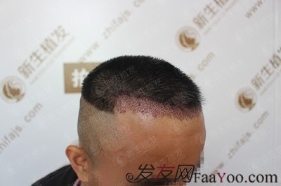 廣州新生植發(fā)發(fā)際線種植，自此以后又多了一個(gè)紀(jì)念日