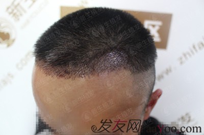 廣州新生植發(fā)發(fā)際線種植，自此以后又多了一個(gè)紀(jì)念日