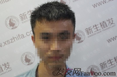 廣州新生植發(fā)發(fā)際線種植，自此以后又多了一個(gè)紀(jì)念日