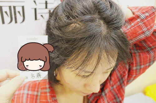 瑞麗詩發(fā)際線種植以后會脫落嗎