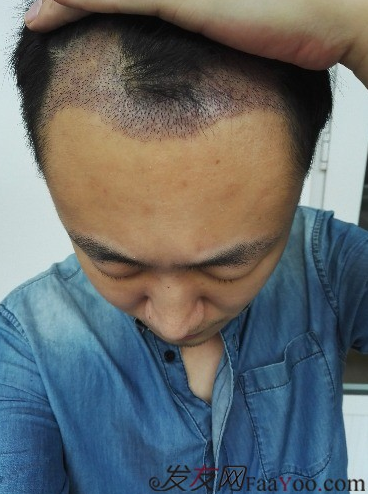 發(fā)際線種植1800單位，六個(gè)月蛻變歷程