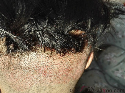 發(fā)際線種植1800單位，六個(gè)月蛻變歷程