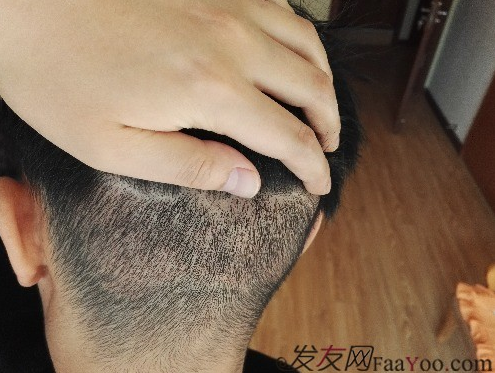 發(fā)際線種植1800單位，六個(gè)月蛻變歷程