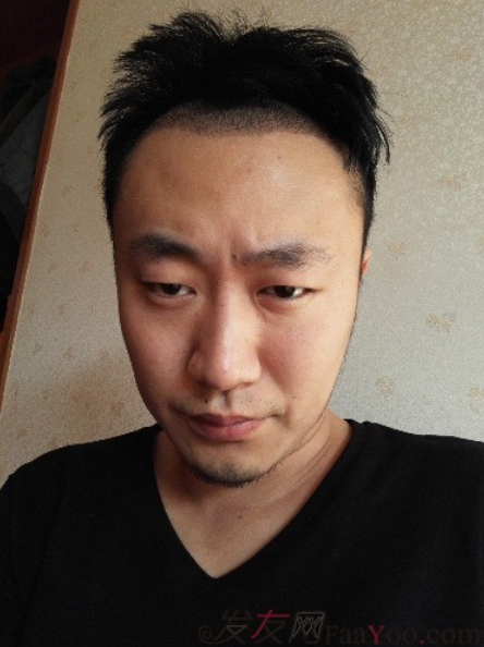 發(fā)際線種植1800單位，六個(gè)月蛻變歷程