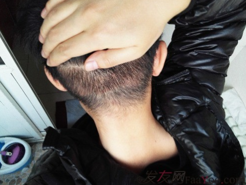 發(fā)際線種植1800單位，六個(gè)月蛻變歷程