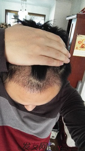 發(fā)際線種植1800單位，六個(gè)月蛻變歷程