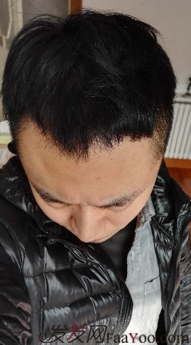 發(fā)際線種植1800單位，六個(gè)月蛻變歷程